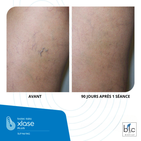 SLP Nd:YAG - avant après