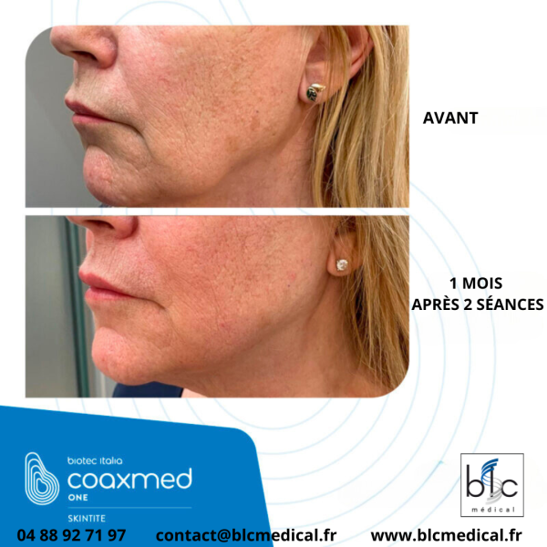 LA PLATE-FORME DE RADIOFRÉQUENCE POLYVALENTE