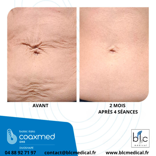 LA PLATE-FORME DE RADIOFRÉQUENCE POLYVALENTE