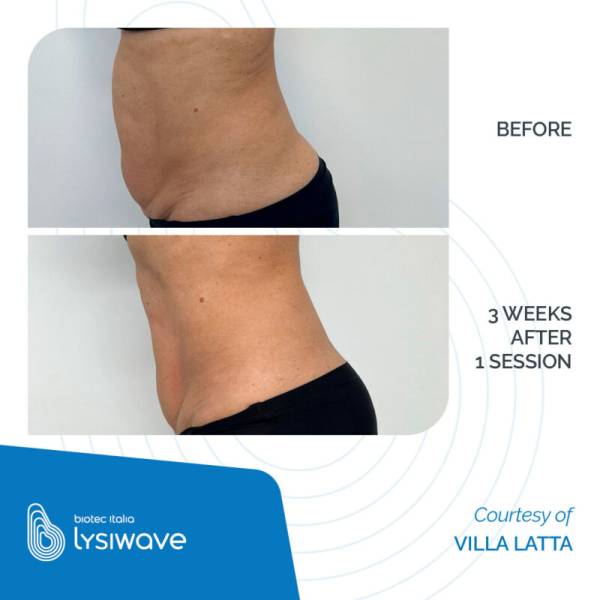 Avant après lysiwe biotec italia 