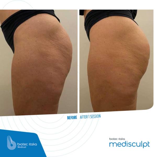 RÉSULTAT AVANT APRÈS MEDISCULPT APPAREIL DE RENFORCEMENT MUSCULAIRE