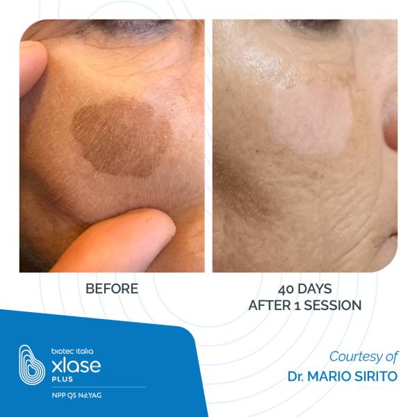  NPP Q-switch Nd:Yag 1064/532nm 