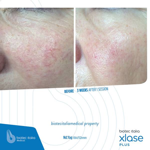 SLP Nd:YAG - avant après