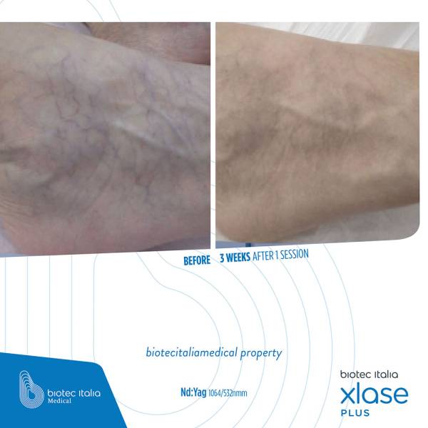 SLP Nd:YAG - avant après